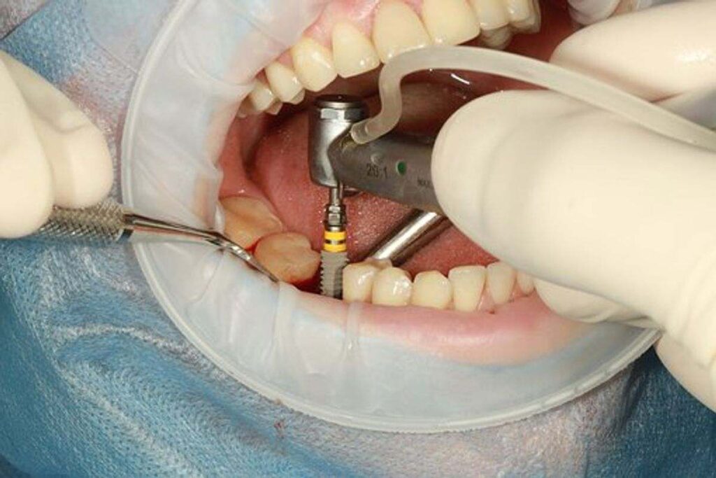 Tooth Implants – What You Should Inquire about Your Dental Implant Cosmetic surgeon