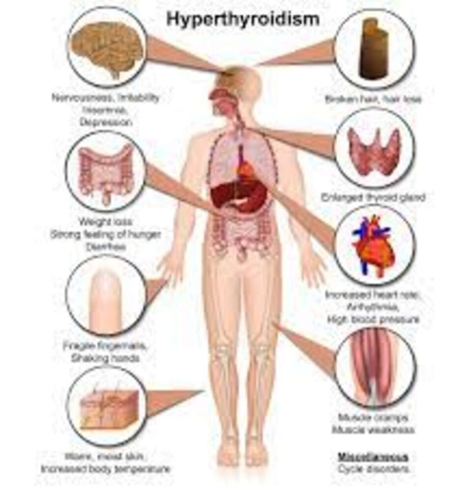 What You Have to Know About Hyperthyroidism