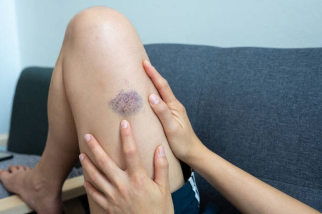 Blood Clot Signs and Prevention