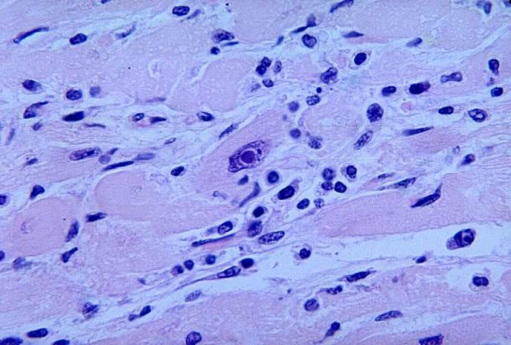 Lung Granuloma – Signs, Etiology, and Therapies