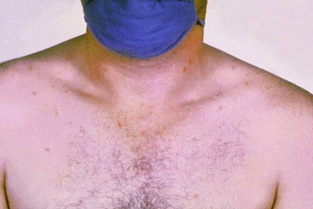 Signs and Remedy of Typhoid Fever
